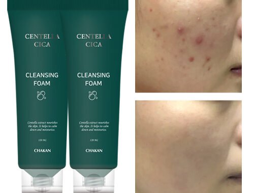 추천 인기 좁쌀여드름 관리 10가지 필수 제품 지금 바로 확인!